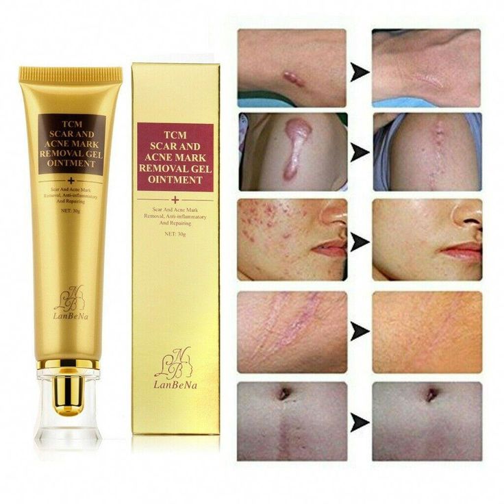 Creme removedor de cicatrizes e manchas