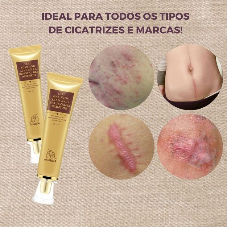 Creme removedor de cicatrizes e manchas