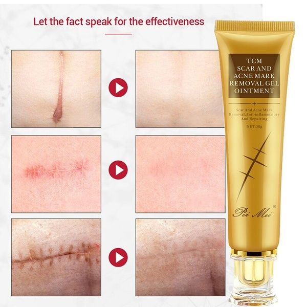 Creme removedor de cicatrizes e manchas